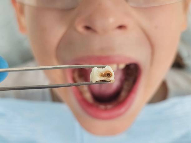 Best Emergency Dentist for Knocked-Out Tooth in Union City, TN