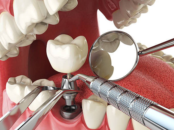 Best Emergency Dental Extractions in Union City, TN